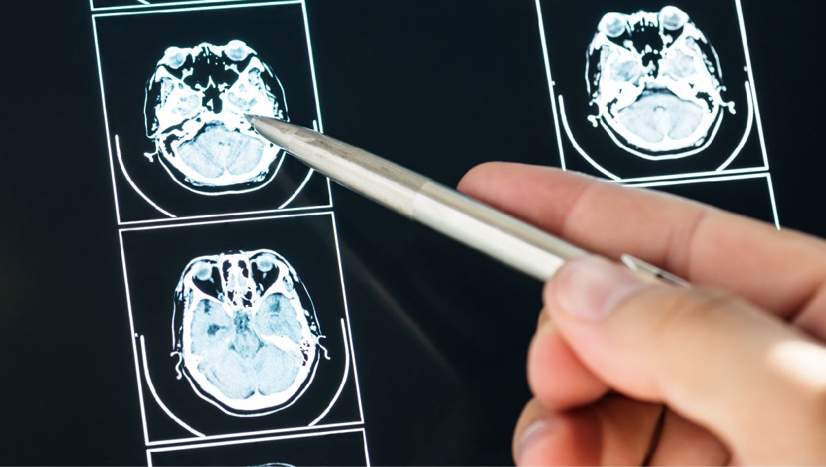 Does Marijuana Boost Brain Power or Harm It? A person's hand as they show something on a brain scan, pointing it with a pen